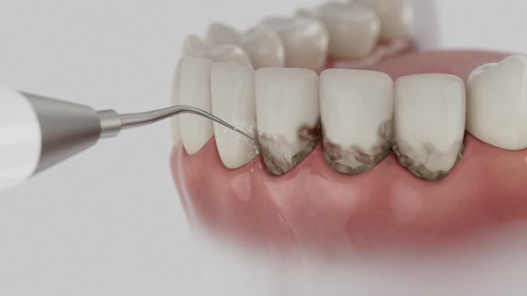 Trusted Wisdom Tooth Removal service in Sapulpa, OK - Dentist Open Now